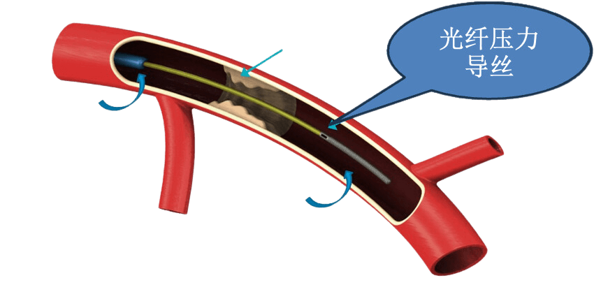 FFR 光纤压力导丝示意图