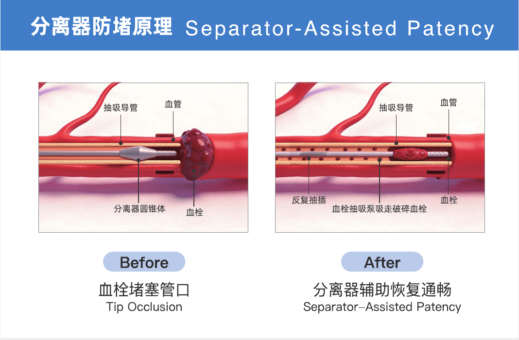 分离器防堵原理 Before After 效果图，展示血栓堵塞管口与分离器辅助恢复通畅