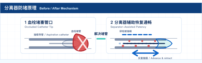 分离器在外周血栓抽吸导管内往复并辅助恢复管腔通畅的原理示意图