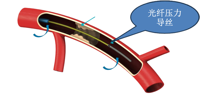 FFR 光纤压力导丝示意图